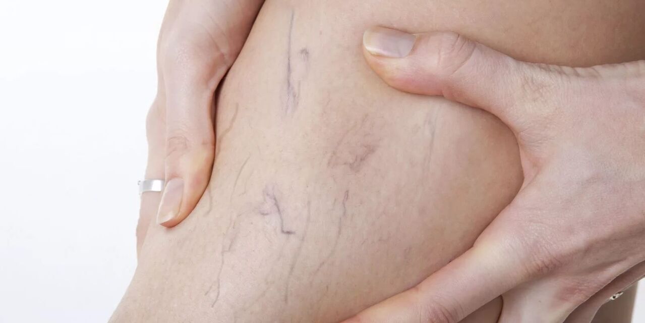 Преди използването на вариконен крем